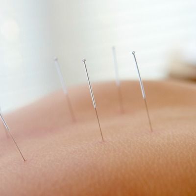 Feine Nadeln für sanfte Akupunktur