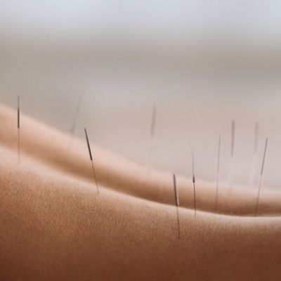 Rücken mit Akupunktur-Nadeln