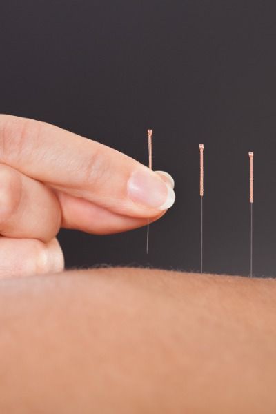 Akupunktur bei Ravensburg